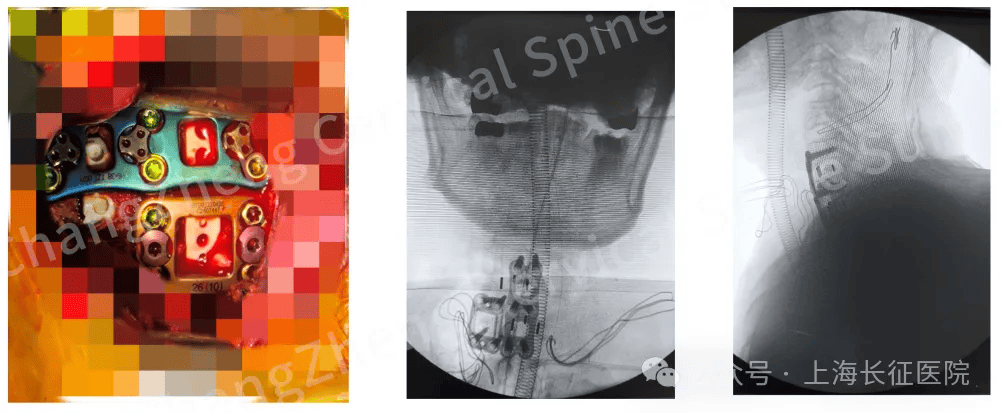 全球罕见！中国医生救回“身首离断”患者