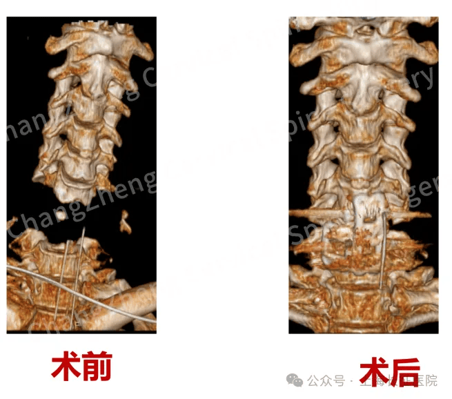 全球罕见！中国医生救回“身首离断”患者